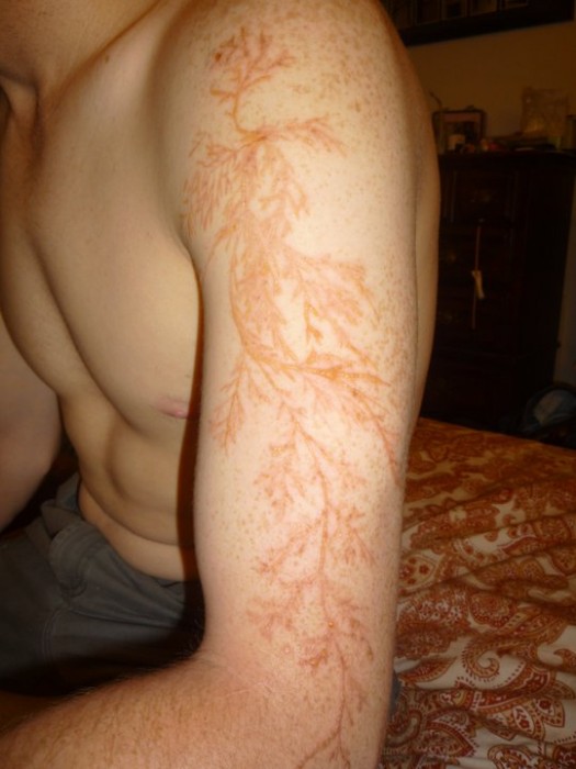 Meet Winston Kemp, Lightning Strike Survivor and Lichtenberg Figure Owner