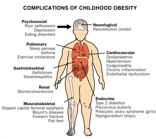 Complications from Childhood Obesity