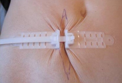 Top Closure Zip Tie Bandages Could Save Lives!