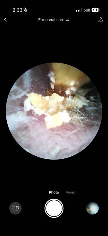 Bebird EarSight Ultra X Review: A 4K Smart Ear Cleaner That Lets You See (and Safely Remove) the Gross Stuff 7 Inside the author's ear using the Bebird EarSight Ultra X